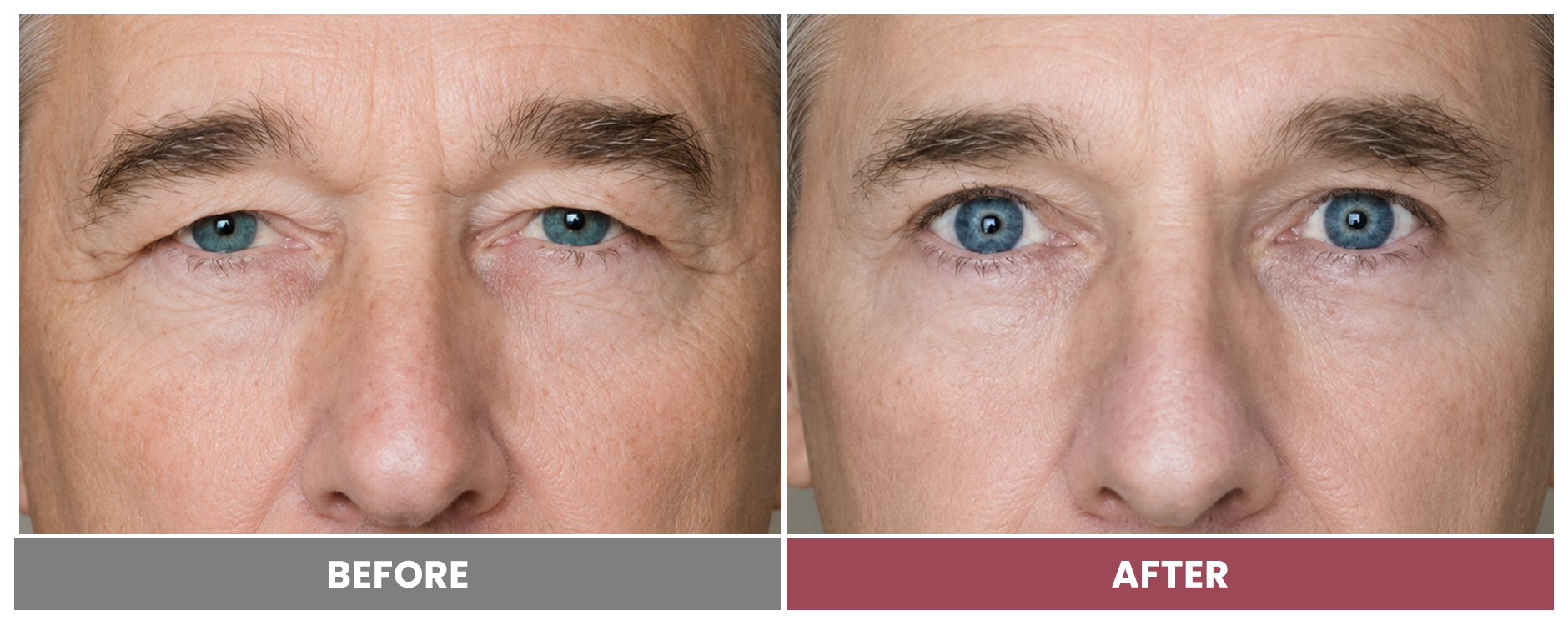 Upper Blepharoplasty - Case 69